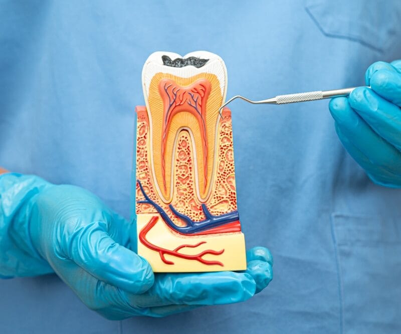 Close-up of a dental professional in blue scrubs and gloves holding a detailed cross-section model of a tooth with visible decay, using a dental probe to point at the root canal - symptoms of failed root canal years later